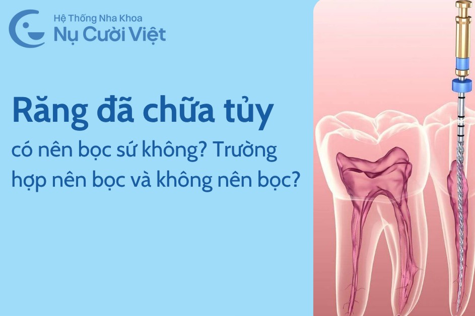 Có nên bọc sứ cho răng đã chữa tủy không? Trường hợp nên bọc và không nên bọc