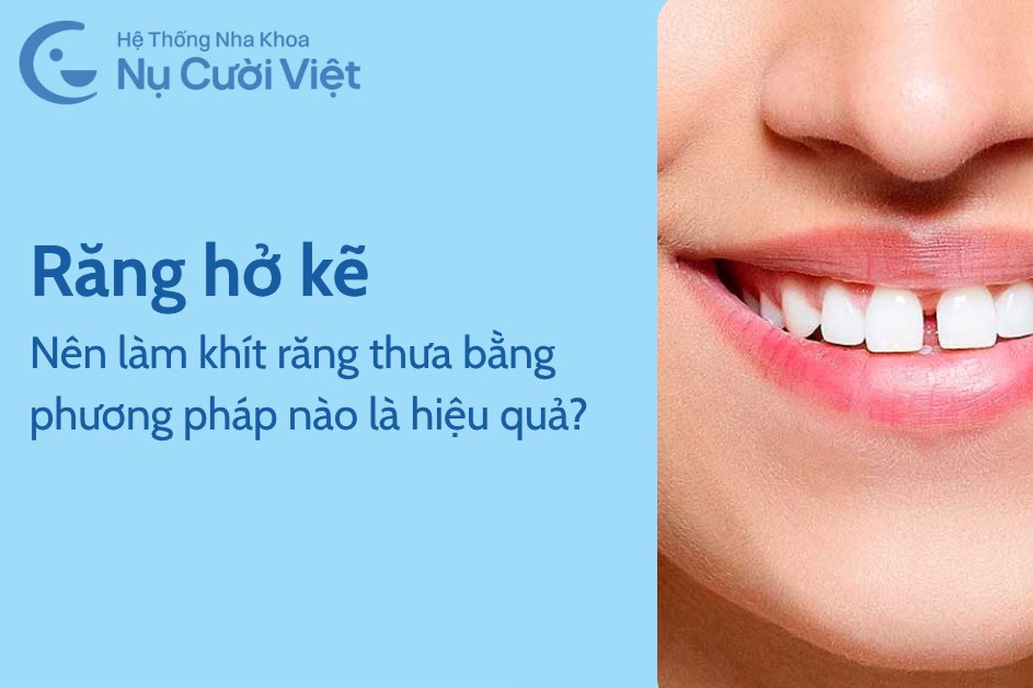 Răng hở kẽ, nên làm khít răng thưa bằng phương pháp nào là hiệu quả?
