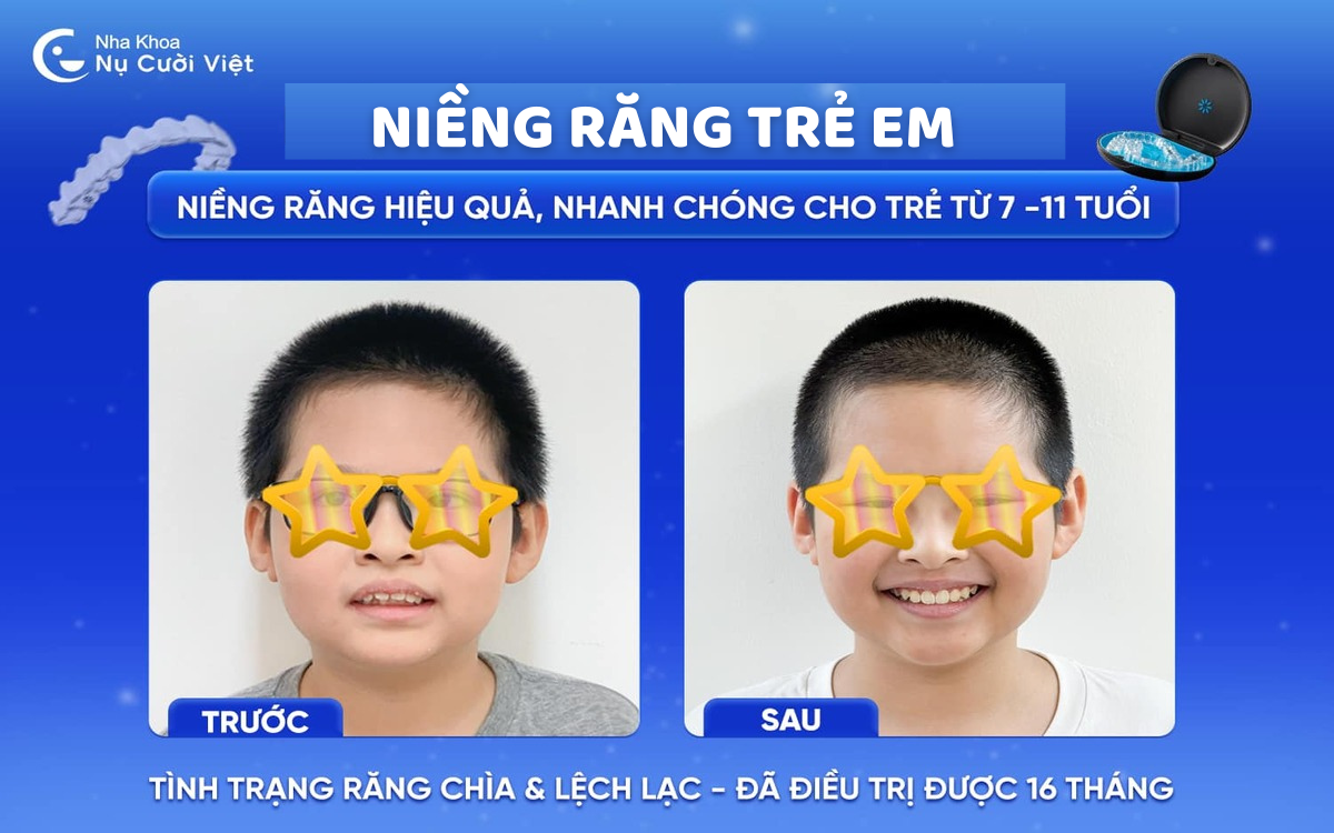 Niềng răng trẻ em gồm những phương pháp nào? Khi nào nên niềng?