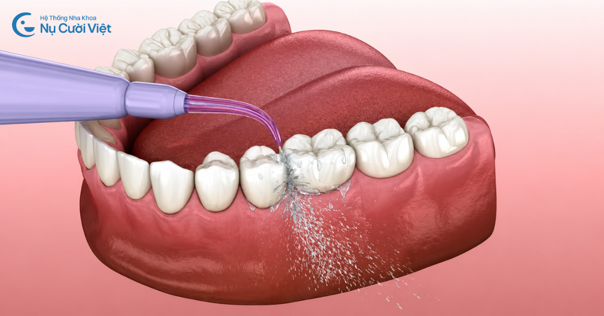 Bọc răng sứ có nên dùng máy tăm nước không?