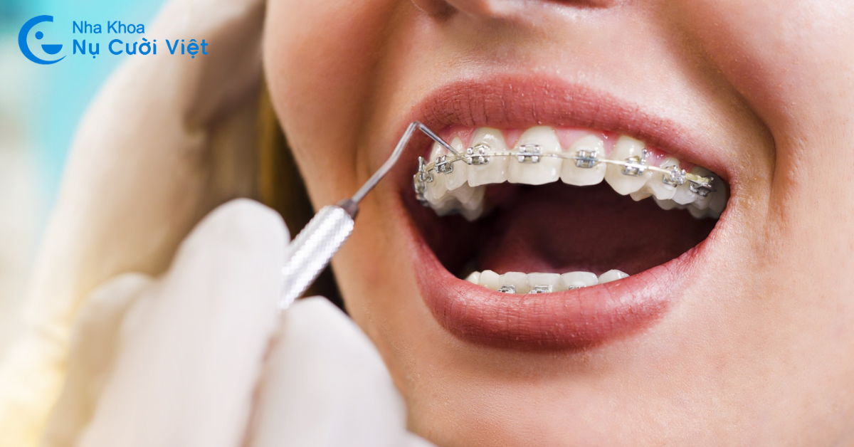 Các loại niềng răng được nhiều người lựa chọn nhất hiện nay
