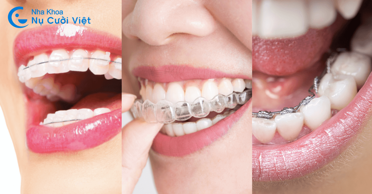 Tư vấn niềng răng: Những giải đáp từ chuyên gia