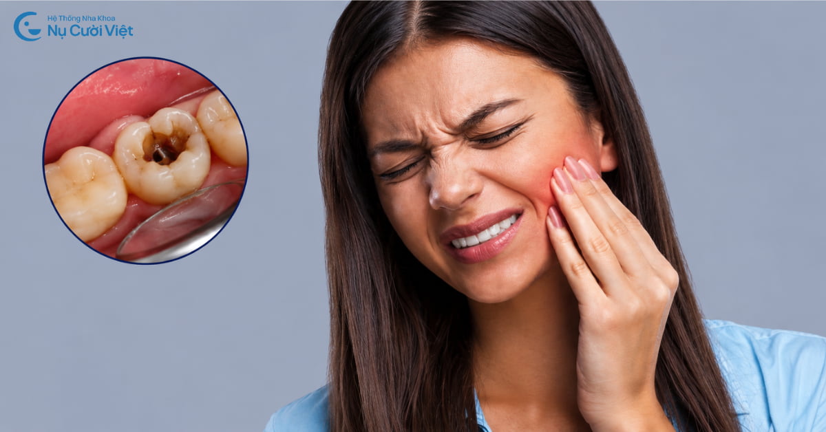 3 mức độ sâu răng từ nhẹ đến nặng: Dấu hiệu nhận biết và cách điều trị từng giai đoạn