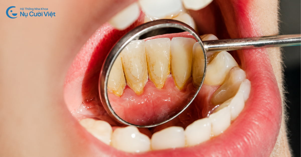 Cao răng tự tróc được không? Khi nào nên lấy cao răng?