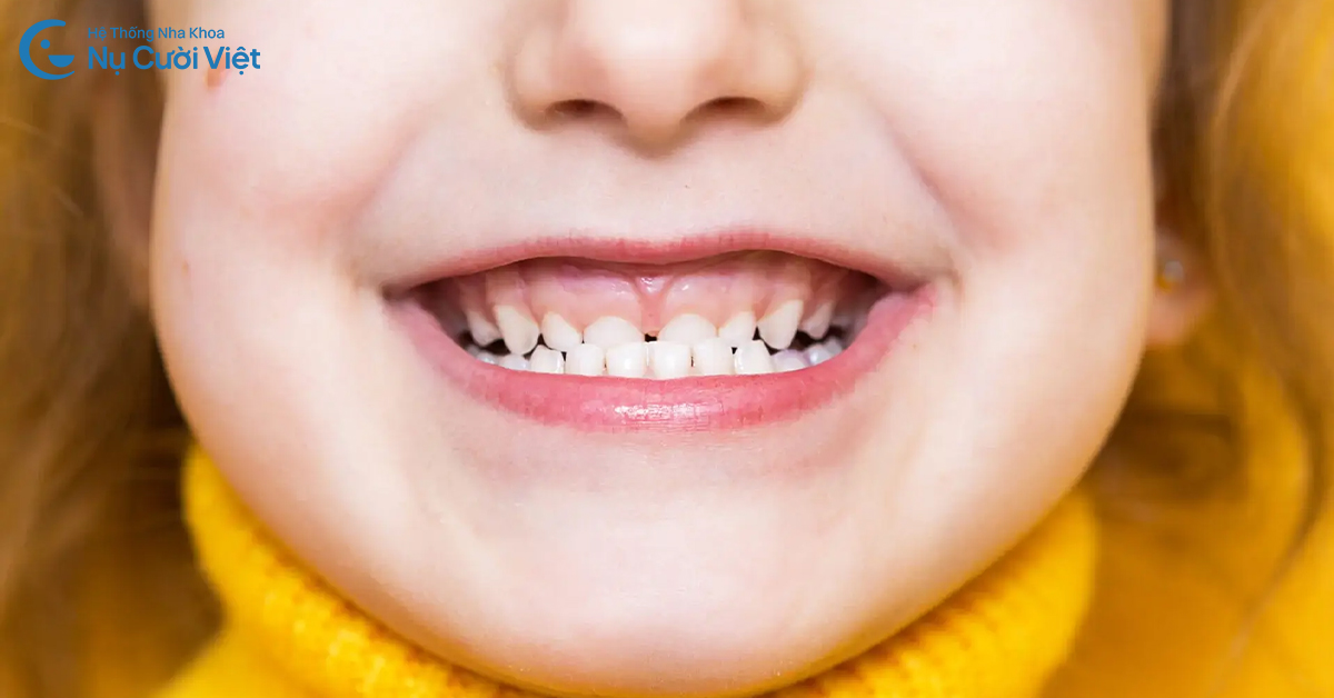 Móm ở trẻ: Vì sao ba mẹ nên niềng răng sớm cho con?