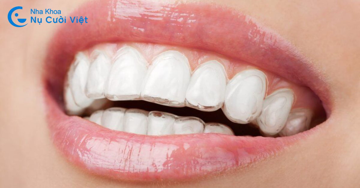 Niềng răng Invisalign là gì?
