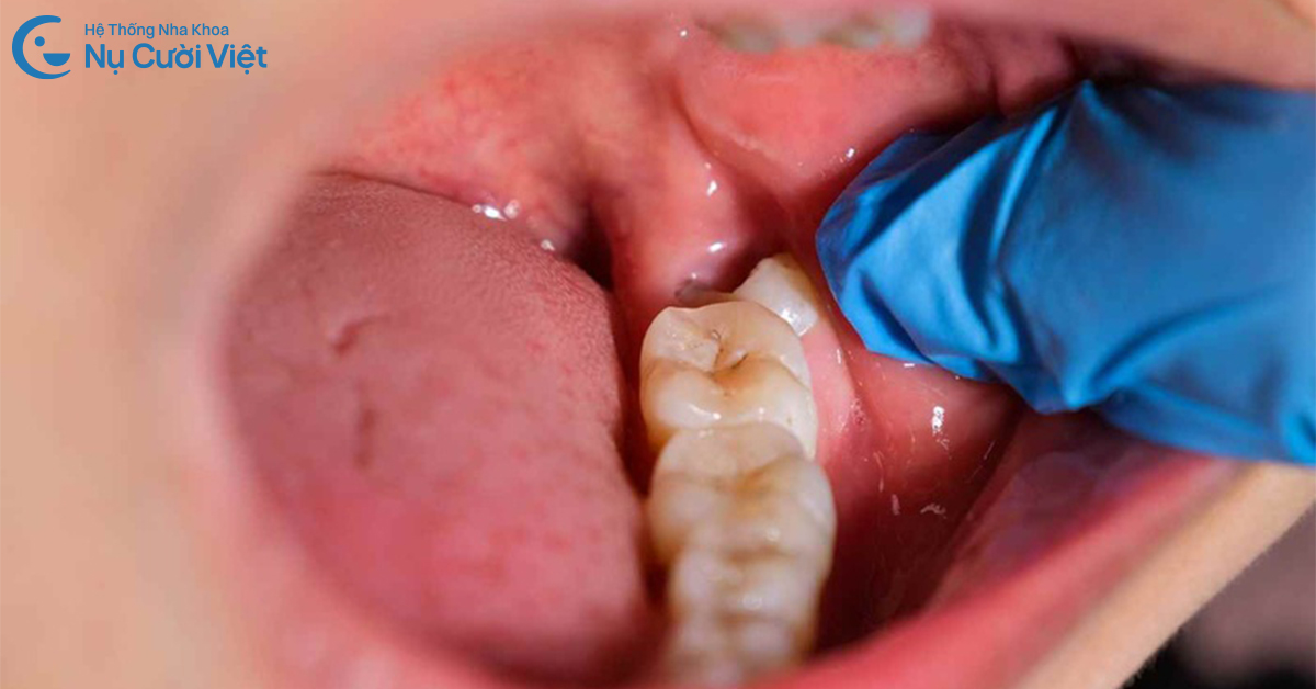răng đau nhức có nhổ được không