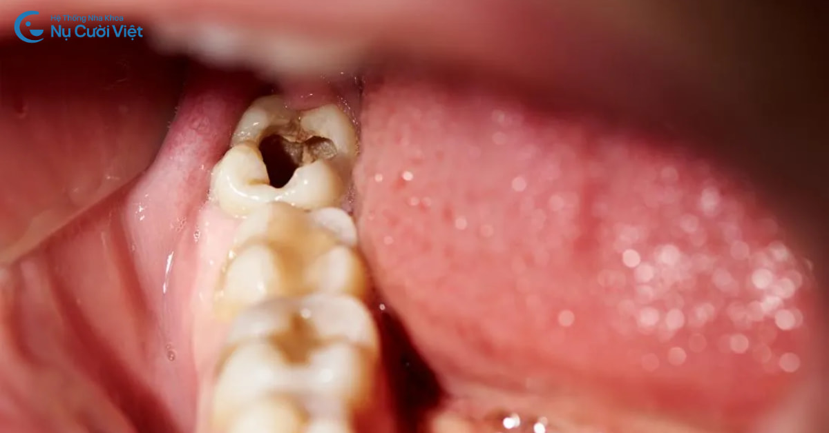 trường hợp răng khôn mọc thẳng cần nhổ