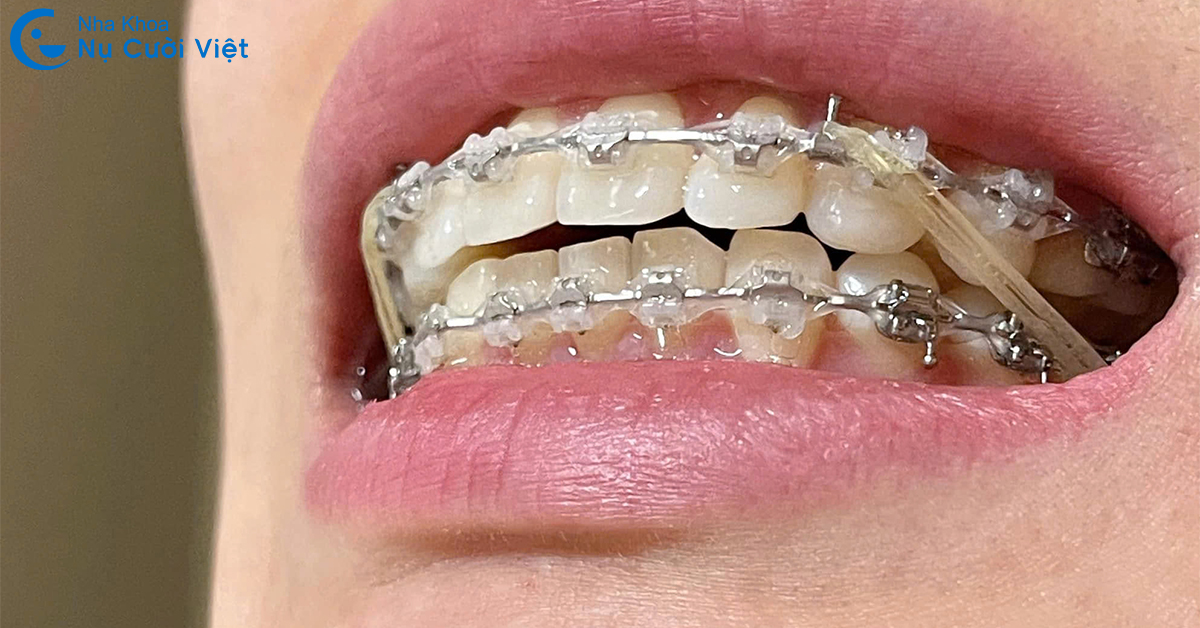 Giải đáp A-Z về các loại thun niềng răng & Công dụng, cách sử dụng