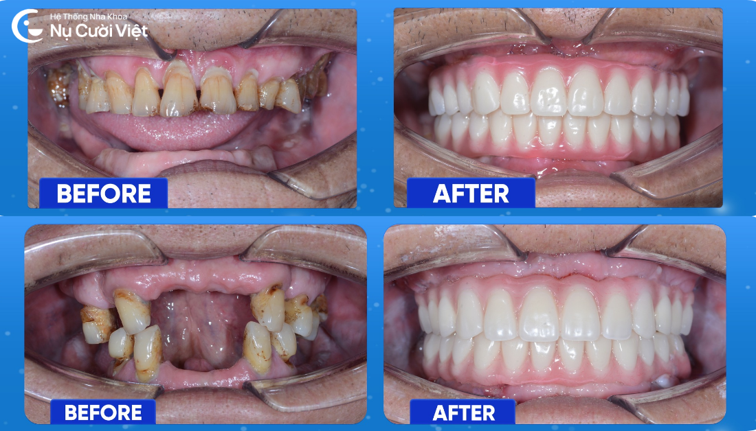 Trồng răng toàn hàm có đau không? Công nghệ trồng răng Implant giúp giảm đau, an toàn