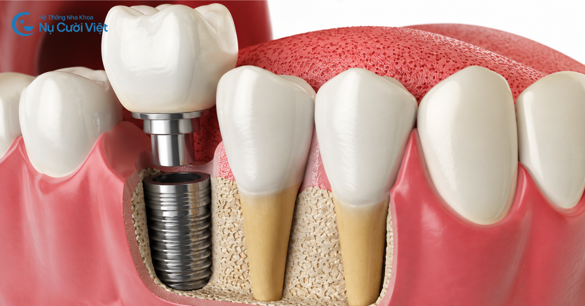 Trụ Implant có bị gỉ sét hay oxy hóa theo thời gian không?