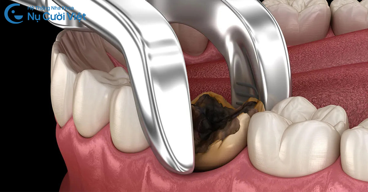 trường hợp được nhổ khi răng đau nhức