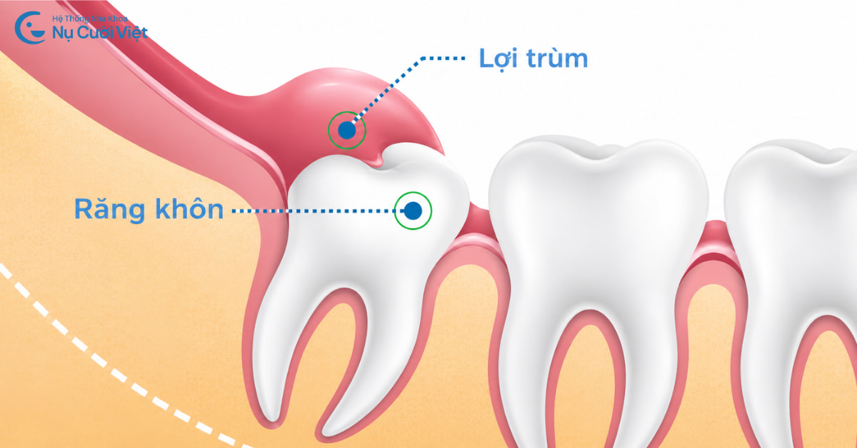 trường hợp răng khôn mọc thẳng không cần nhổ