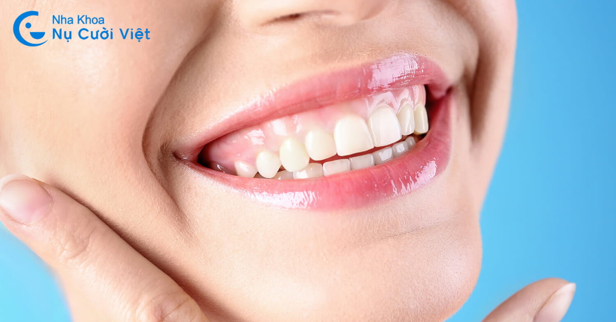 [BẠN CẦN BIẾT] Cách chữa cười hở lợi được ưa chuộng nhất hiện nay