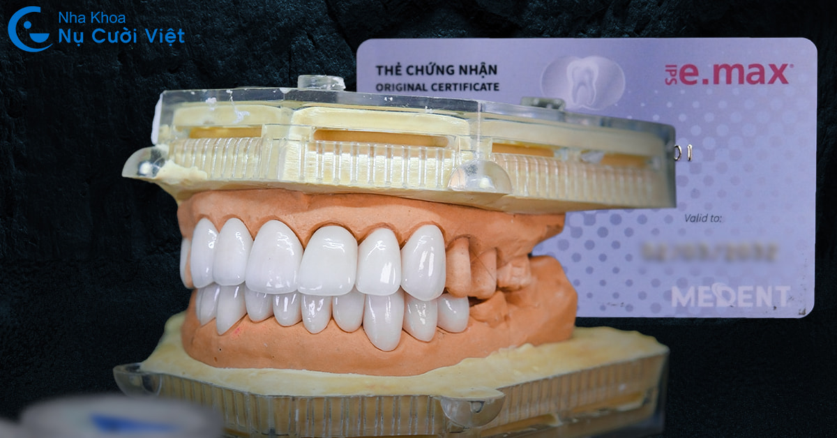Dán sứ veneer có bền không? Yếu tố ảnh hưởng độ bền của dán sứ veneer