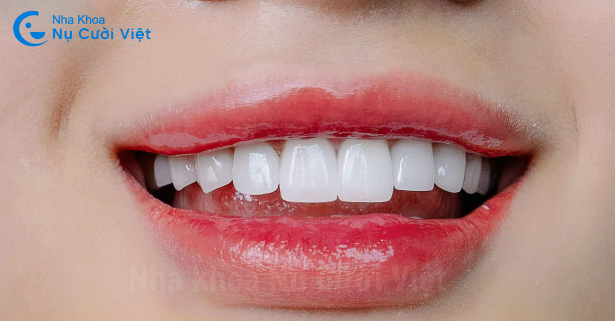 Làm răng thỏ là gì? Phương pháp làm răng thỏ trắng đẹp hợp với khuôn mặt nhất