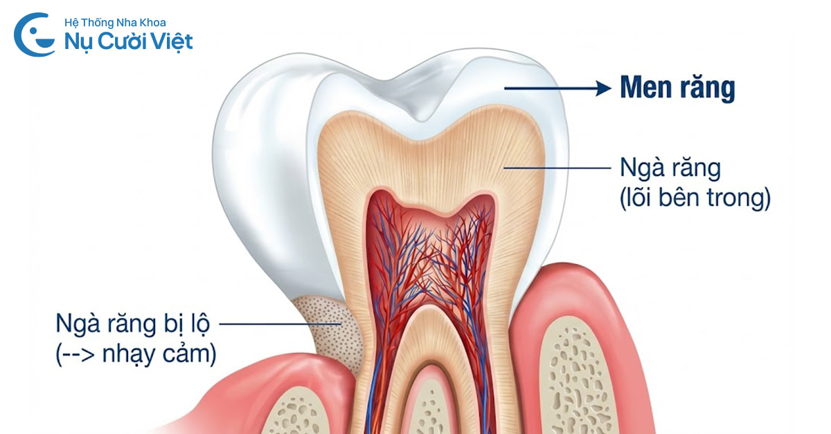 Tẩy trắng răng có làm hại đến men răng không?
