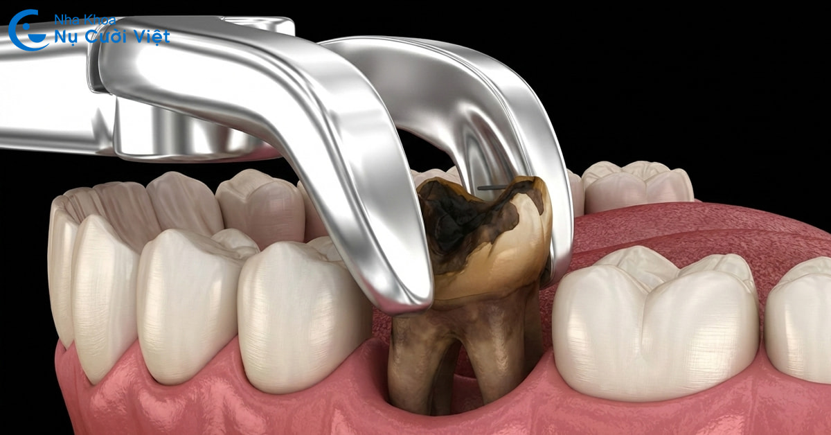 Nhổ răng xong bao lâu thì trồng lại được? Nếu không trồng thì có sao không?