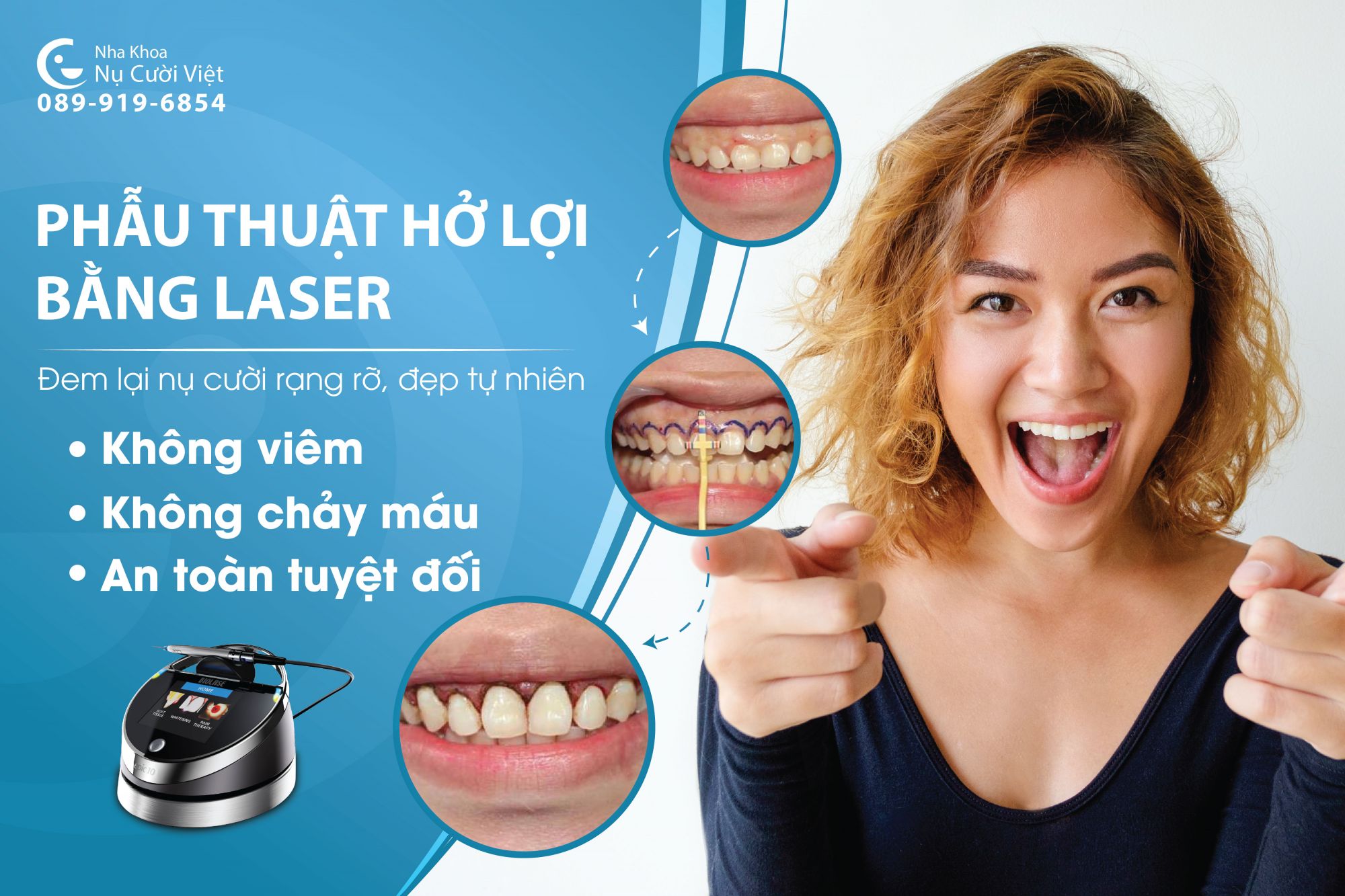 Phẫu thuật cắt nướu laser 3.0 có đau không? Quy trình như thế nào?