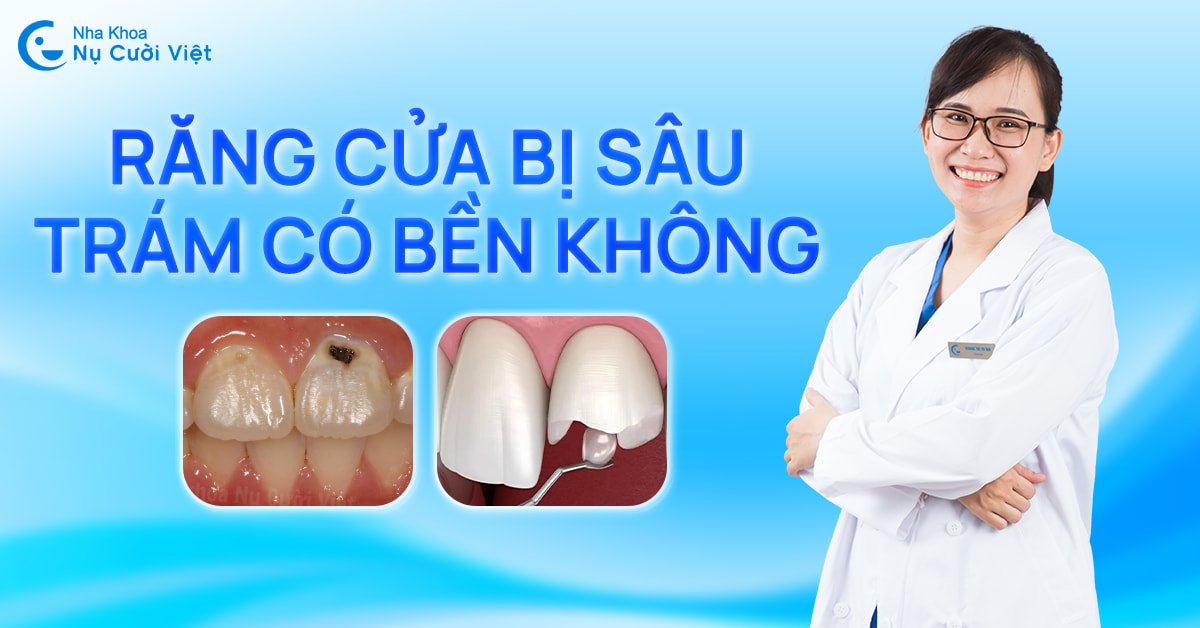 Trám răng cửa sâu có bền không? Chọn vật liệu nào để duy trì thẩm mỹ và chức năng lâu dài?